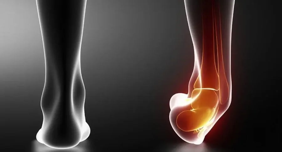 Medical illustration of x-ray showing injury and pain in ankle