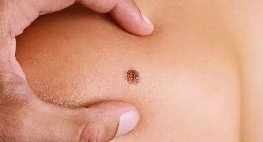 Dark mole on the skin of the chest examined by a dermatological specialist