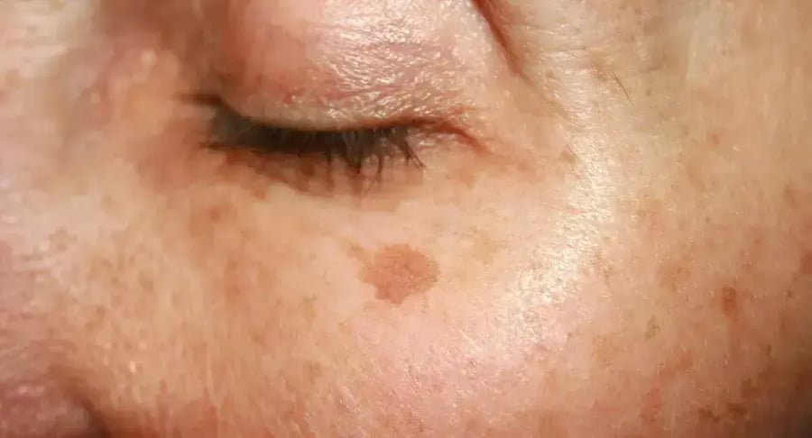 Facial skin spotting near the eye as a sign of hyperpigmentation
