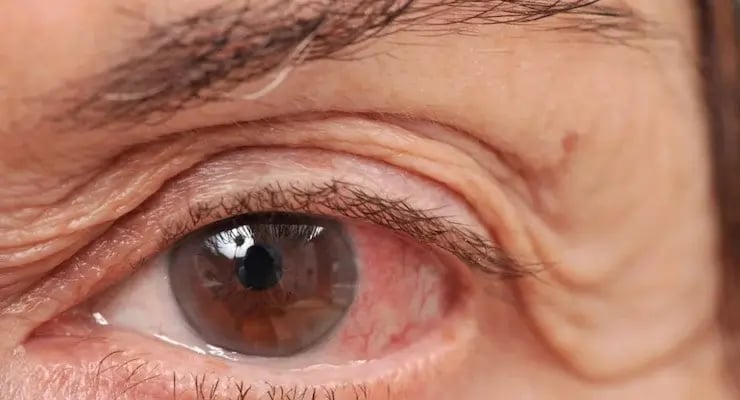 Human eye with pterygium or ocular fleshiness visible on conjunctiva