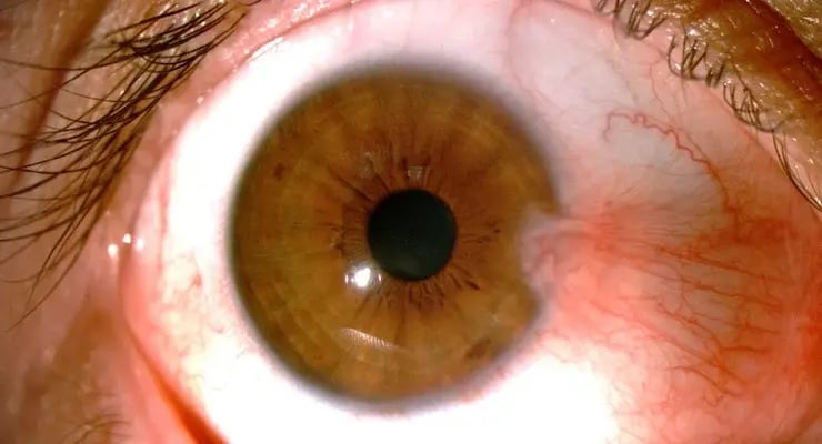 Close-up of human eye with visible signs of diabetic retinopathy