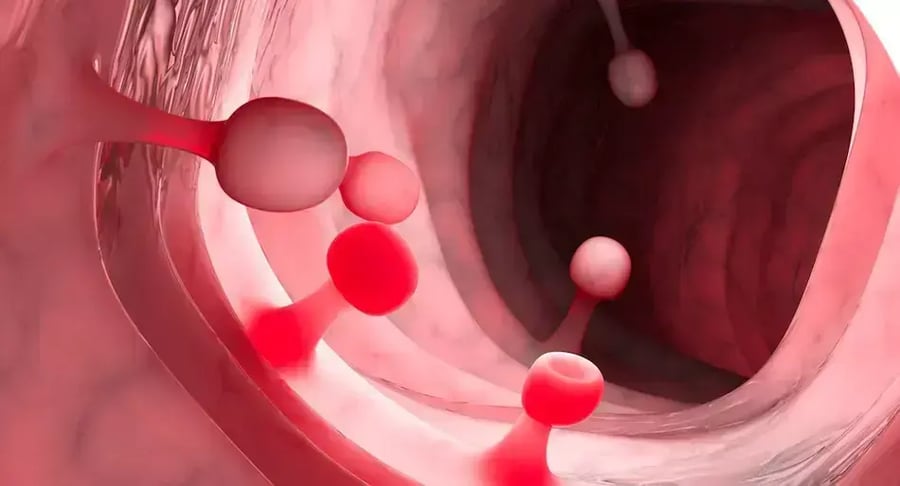Medical illustration of colon polyps requiring polypectomy