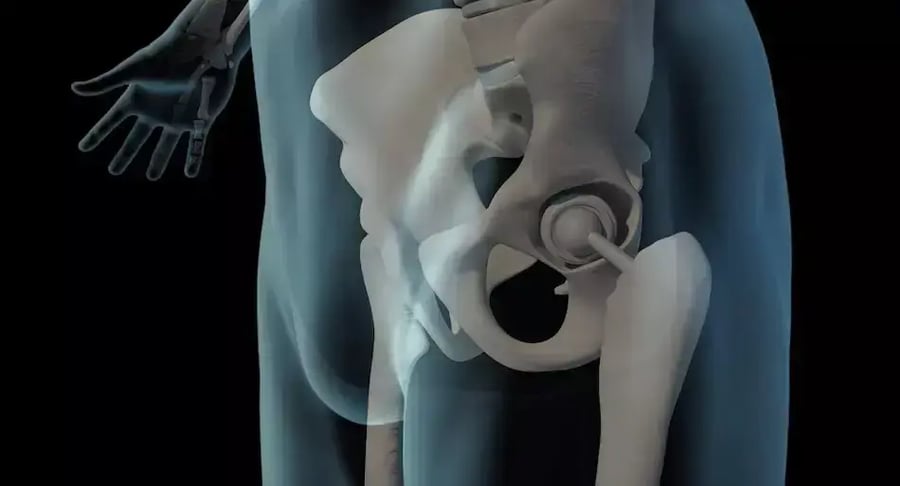 X-ray showing hip prosthesis in the human body