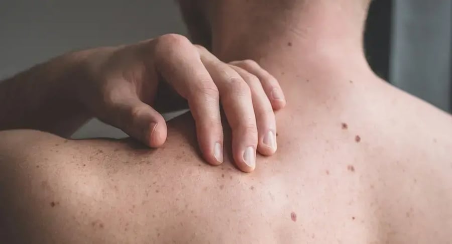 Man with visible moles on his back checking his skin for cancer prevention