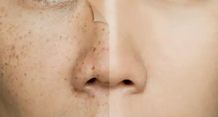 Female face with skin blemishes before and after dermatological treatment