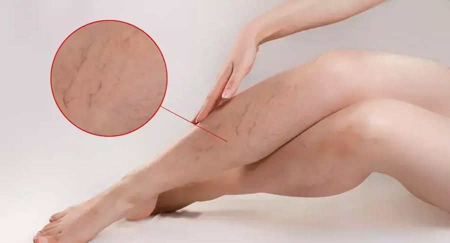 Legs of a woman with visible varicose veins and approaching dilated veins