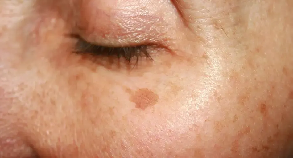¿Por qué se hacen manchas en la piel y cómo tratarlas?